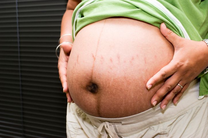 Linea nigra: When does the pregnant belly line appear and why?